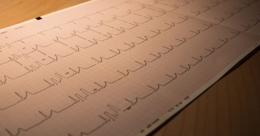ECG heartbeat waveform printed on medical chart paper